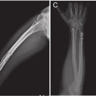 A D Preoperative Posterior Anterior And Lateral Radiographs Of A