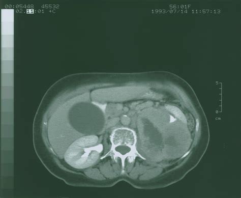 Ct Scan Showing Kidney Cancer Axial Section Photograph By Science