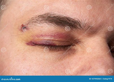 Close View of a Black Eye, Man`s Face with a Hematoma Stock Photo ...