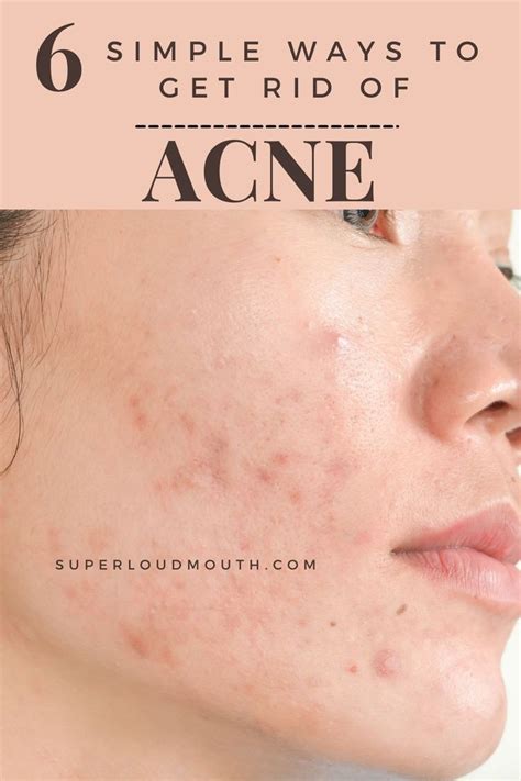 Beauty Hacks For Acne Artofit