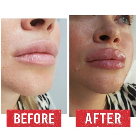 Before After Gallery Fillers Treatments Aesthet House