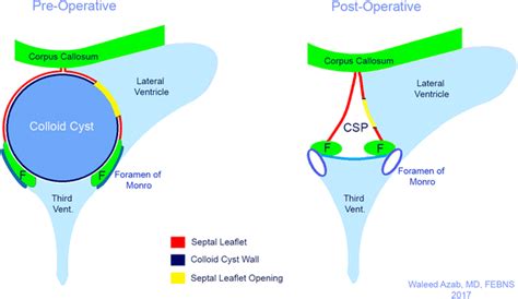 Illustration Of The Patho Anatomical Relations Of Large Colloid Cysts Download Scientific