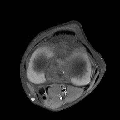 Baker Cyst Image Radiopaedia Org