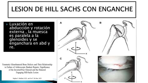 Tecnica De Latarjet Inestabilidad De Hombro Luxaci N De Hombro Ppt