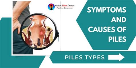 Symptoms and causes of piles by vitthalpiles - Issuu