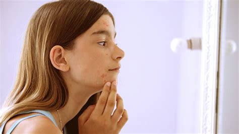 Kids as young as 7 or 8 now breaking out in acne: dermatologist | CTV News