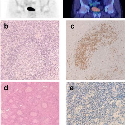 Imaging And Pathological Findings Of Imcd Case 1 And Case 2 Case 1