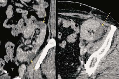 Contrast Enhanced Ct Defects Of Contrast Opacifi Cation Of The Renal Download Scientific