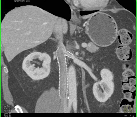 Inferior Vena Cava Ivc Stent With Ivc Reconstruction With 3d Mapping