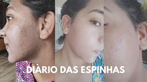 DIÁRIO DAS ESPINHAS TRATAMENTO DE ACNE VITANOL A ADACNE CLIN