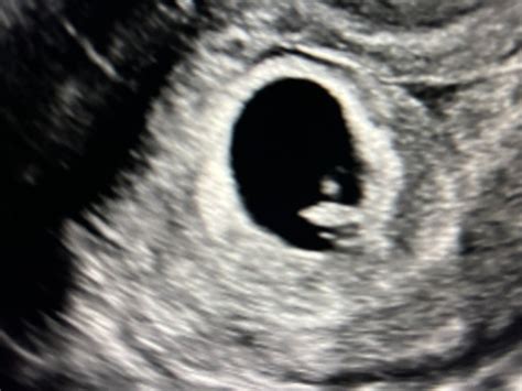 Ultrasound April Babies Forums What To Expect