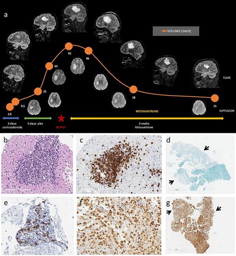 Magnetic Resonance Imaging And Biopsy Neuropathological Findings A MRI