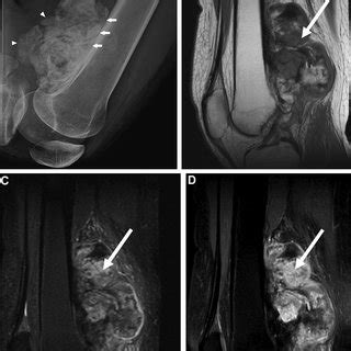 A 32 Year Old Man With Dedifferentiated Parosteal OGS At Right Distal