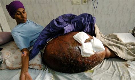 Doctors Remove Giant 55kg Tumour Worlds Largest That Weighed More