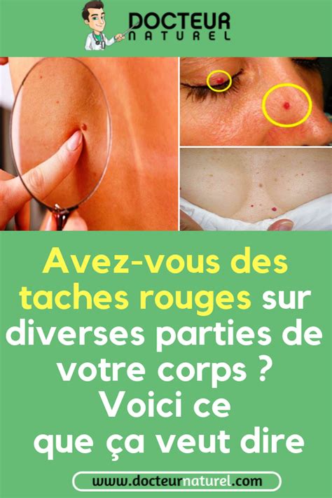 Voici Comment Traiter Naturellement Les Taches Rouges Sur La Peau Peau