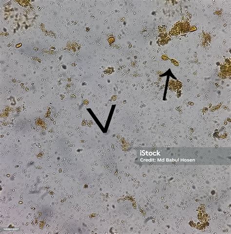 Microscopic Examination Of Stool Showing Blastocystis Hominis Parasite Blastocystosis Stock