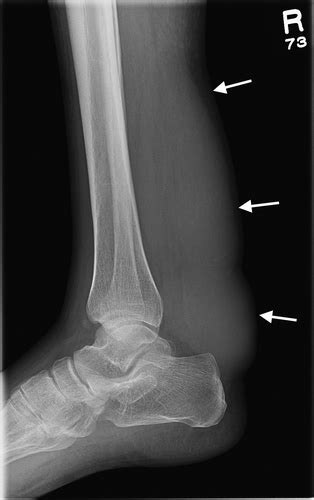 Case 239 Cerebrotendinous Xanthomatosis Radiology