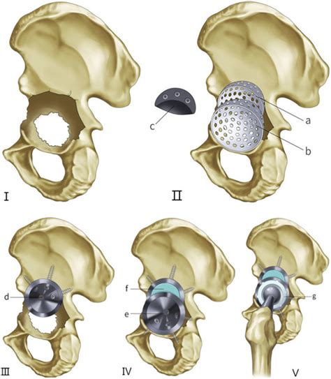 Mid Term Results Of Revision Surgery Using Double Trabecular Metal Cups