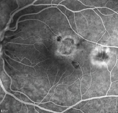 Ae Active Recurrent Toxoplasma Retinochoroiditis In A Yo Woman