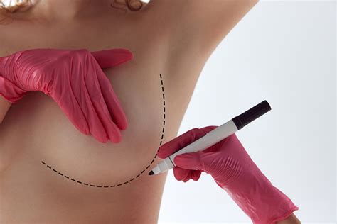 Breast Lift Augmentation Daniel Reichner Md Facs