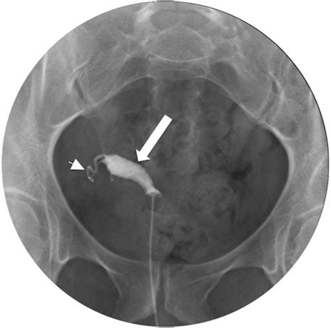 Sonographic Findings Of Early Pregnancy In The Rudimentary Horn Of A