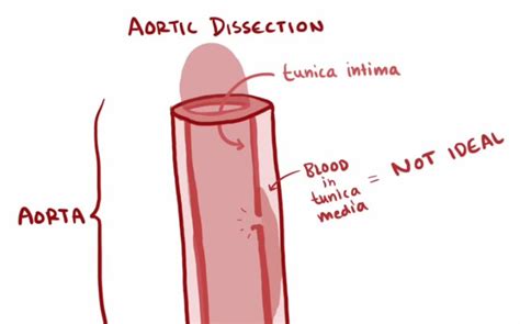 Osmosis Aortic Dissection Bilibili