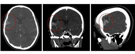 Contrast enhanced CT scan was requested which showed tuft of tortuous... | Download Scientific ...