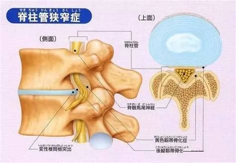 病例：椎間孔鏡技術治癒腰椎間盤突出症繼發椎管狹窄一例 每日頭條