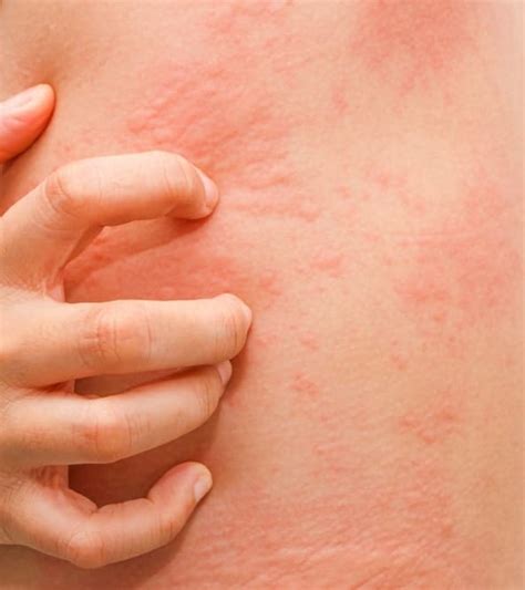 Skin Allergies Know About Disease Treatments And Cost Skinaa Clinic