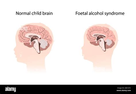 Syndrome Dalcoolisme Foetal Banque De Photographies Et Dimages à