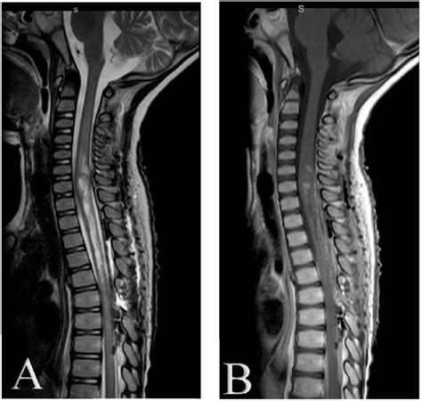 Post Operative Mri The Spine Sagittal T2 A And Gadolinium Enhanced