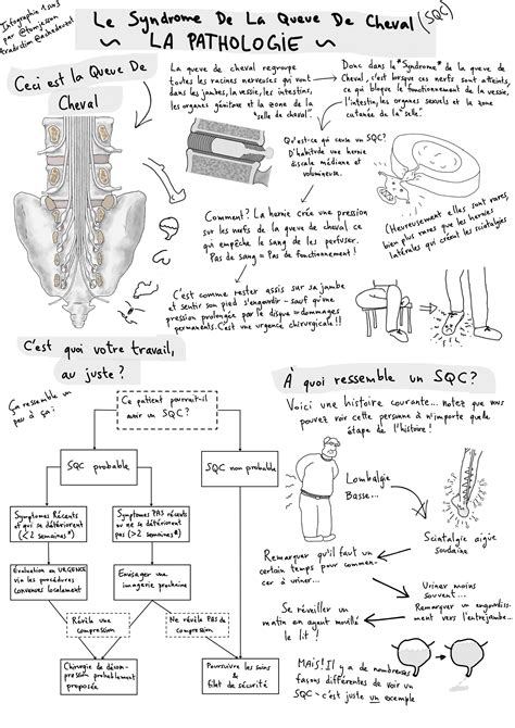 Bd Sur Le Syndrome De La Queue De Cheval Identification Conduite