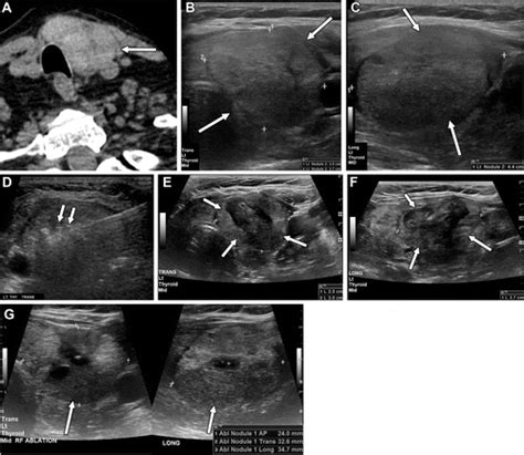 Radiofrequency Ablation Of Benign And Malignant Thyroid Nodules