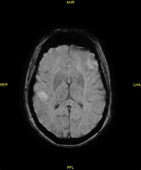 Hemorrhagic Cerebral Metastases From Malignant Melanoma Image