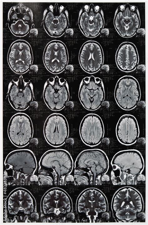 Human Brain Mrt Scans Computer Tomography Ct Photos Of Human Brain