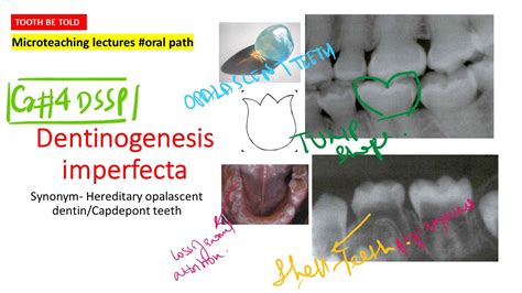 Dentinogenesis Imperfecta | Type 1 and 2 |High yield points with diagrams|NEET MDS | INI-CET ...