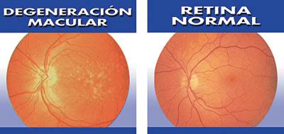 Investigaci N En El Tratamiento De La Degeneraci N Macular Asociada A