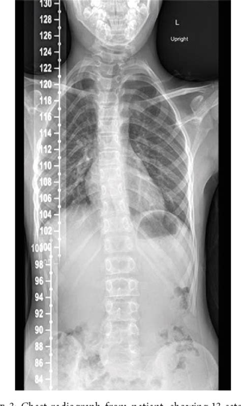 Figure 1 from Bilateral Radial Ulnar Synostosis and Vertebral Anomalies ...