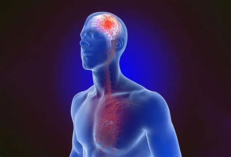 Transient Ischemic Attack Tia Mini Stroke Symptoms Causes