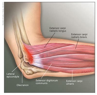 lateral epicondylitis  pain source  learning  pain