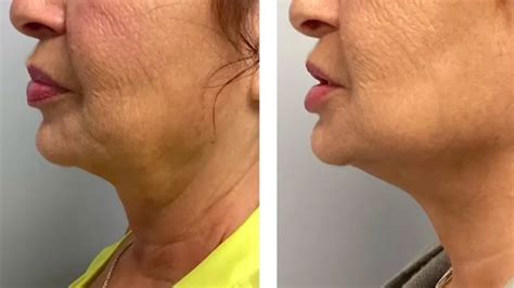 Microneedling Before And After Photos That Show Results First For Women