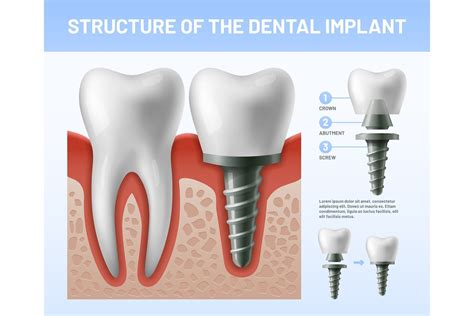 Tooth Dental Implant Graphic By Tartila Stock Creative Fabrica