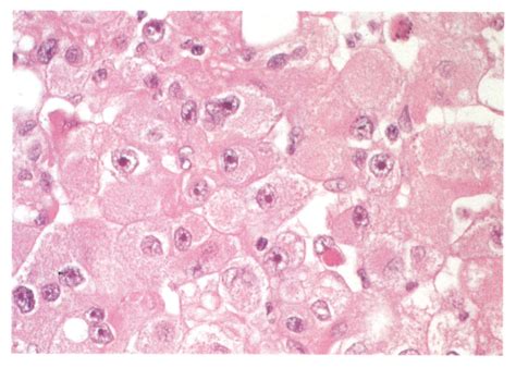 Fine Needle Aspiration Biopsy Diagnosis Of Renal Cell Carcinoma A