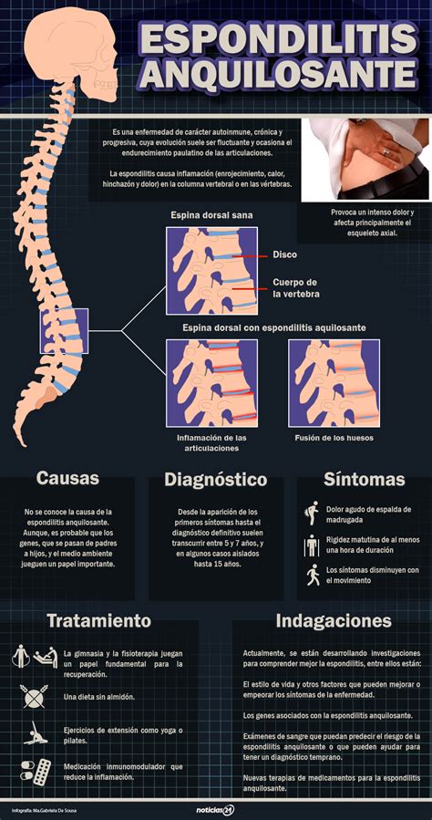 O que é Espondilite Anquilosante Espondilite anquilosante Espondilite