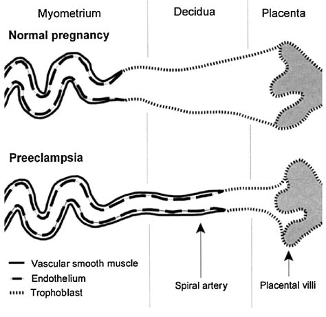 Trophoblast Mediated Remodelling Of The Uterine Spiral Arteries In