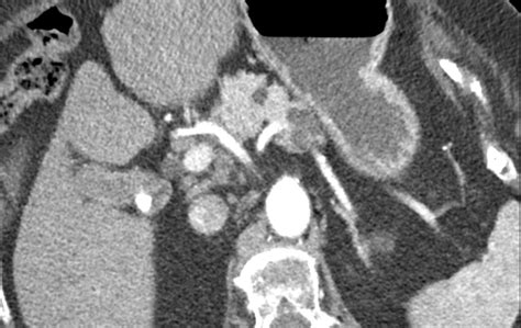 Intraductal Papillary Mucinous Neoplasm Side Branch Type CT Image