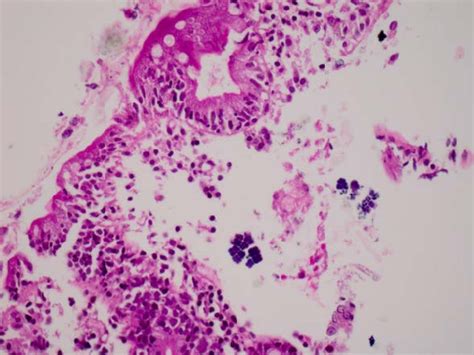 Sarcina Ventriculi Characteristically Appearing In Groups Of Or