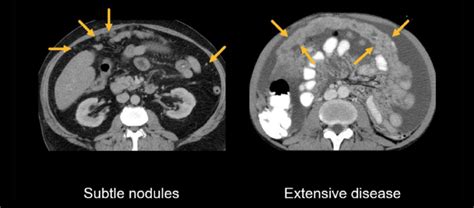 Abdominal Ct Peritoneal Cavity • Litfl • Radiology Library