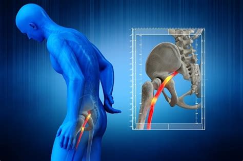 Sciatique Comment La Soigner Et Soulager La Douleur Conseil Sant