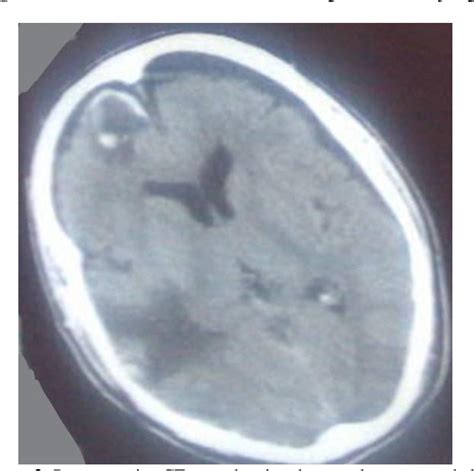 Pdf Management Of Post Traumatic Tension Pneumocephalus Semantic